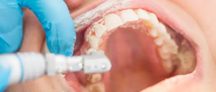 How Sealants Are Applied