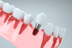 image showing how dental implants are installed in the gums