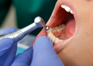 professional dental cleaning