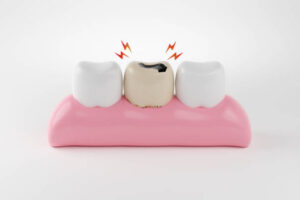 a photo showing a decayed tooth between two healthy teeth