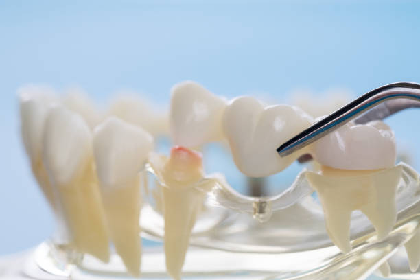 a dental model showing how a dental bridge works