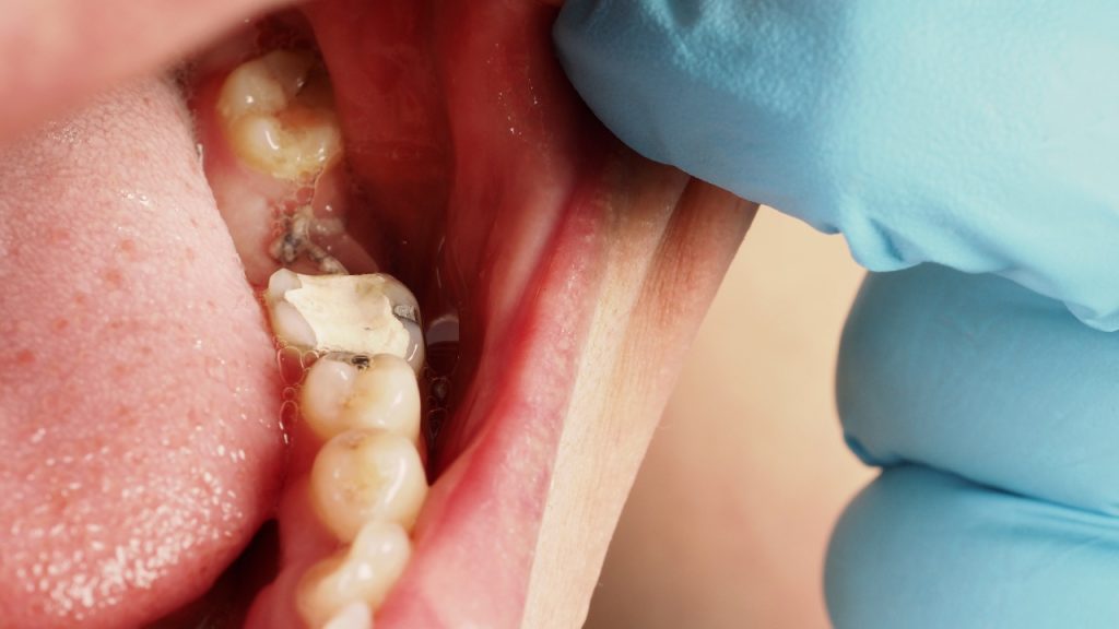 How We Treat Lost Fillings & Crowns