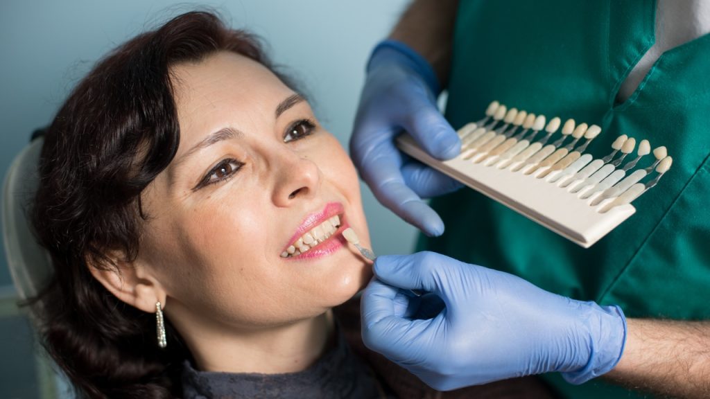 What Are Veneers
