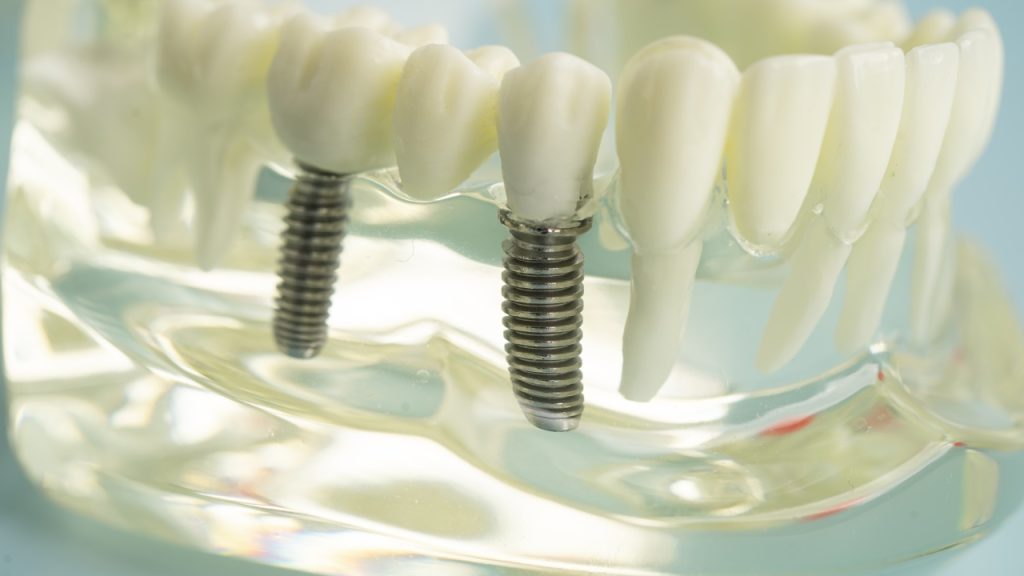 What Is a Dental Implant