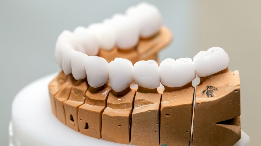 What Is an Implant Bridge