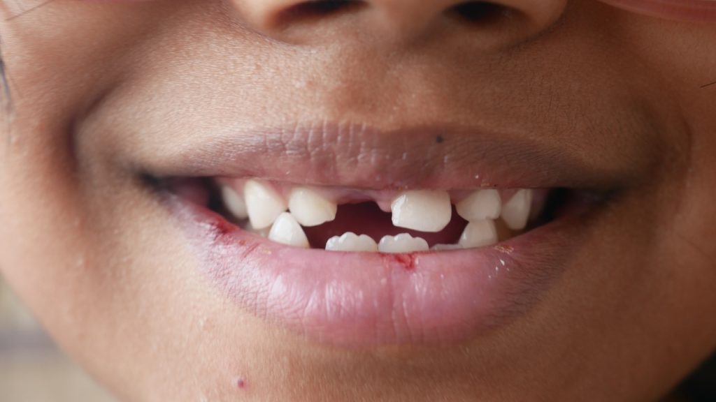 When to Call About a Broken Tooth