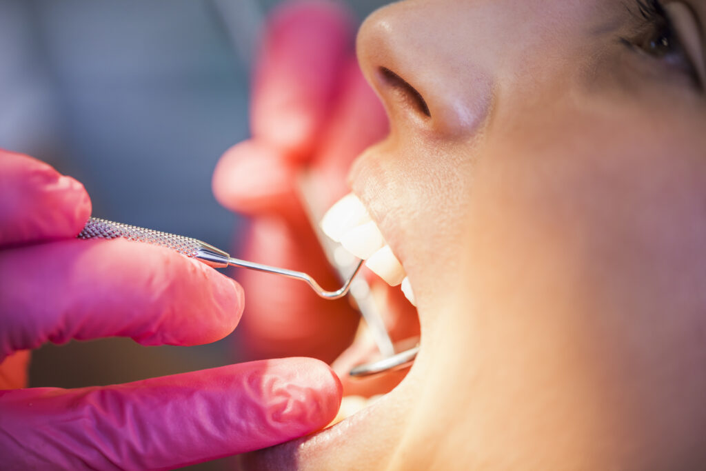 tooth-colored-fillings