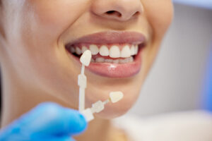 porcelain-veneer-placement