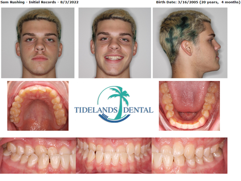 Invisalign Surfside Beach, SC | Remote Clear Aligners with Dr. Jared Little