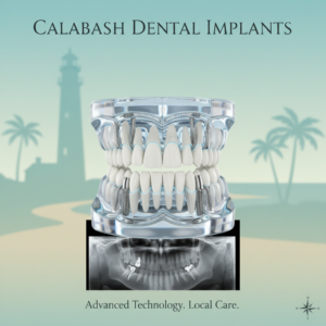 full arch dental implants calabash nc