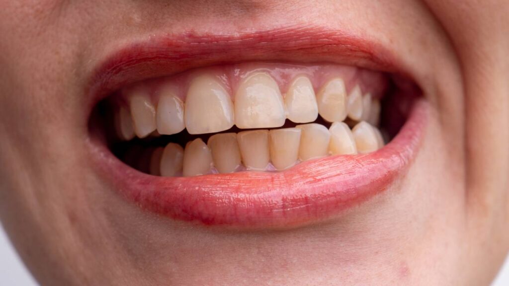 How to Reverse Gingivitis at Home Before It Gets Worse