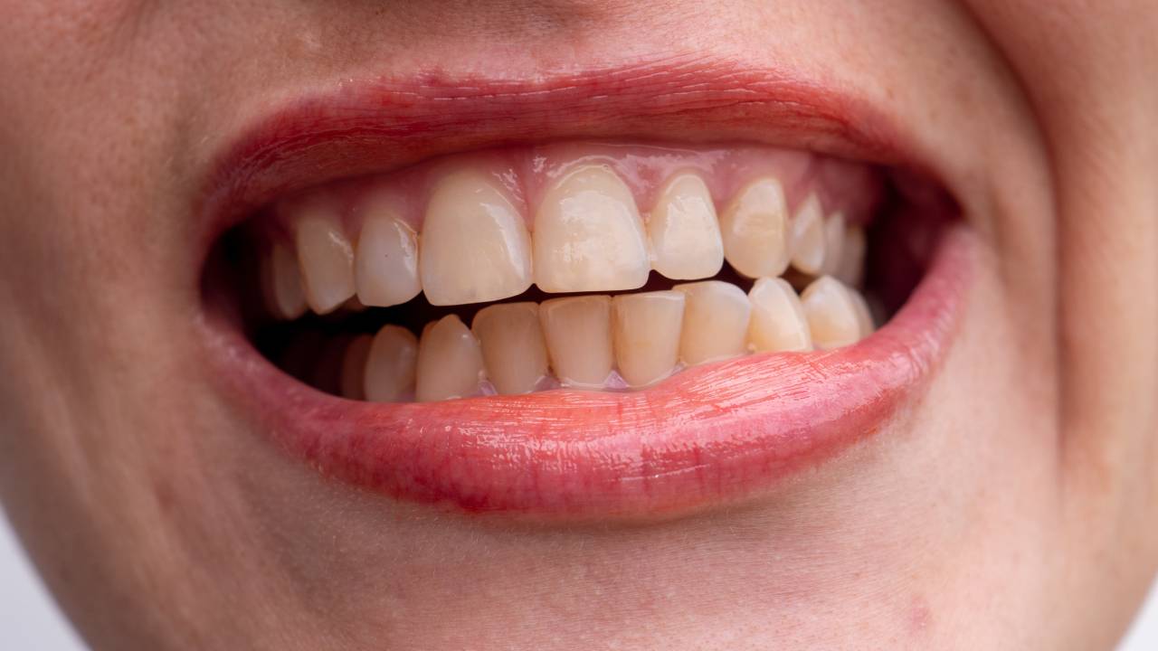 How to Reverse Gingivitis at Home Before It Gets Worse